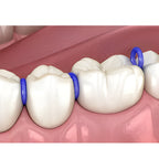 Orthodontics sperators